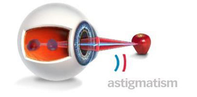 astigmatism