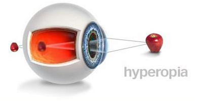 hyperopia