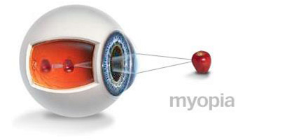 myopia image